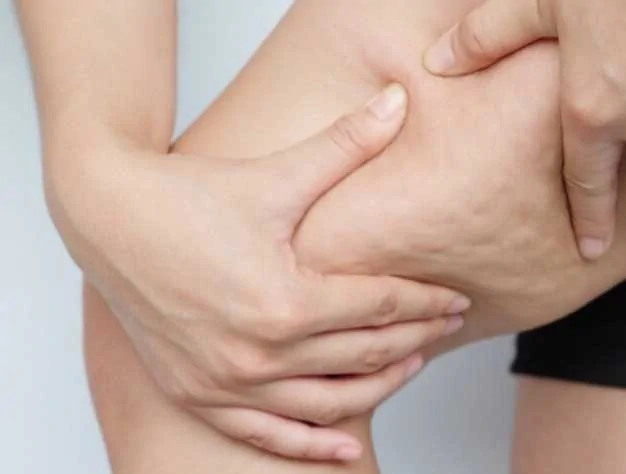 Rimedi naturali contro la cellulite