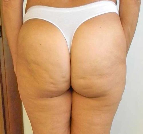Cellulite: rimedi naturali per combatterla  che forse ancora non conosci