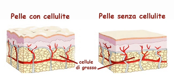 Cellulite: rimedi naturali per combatterla