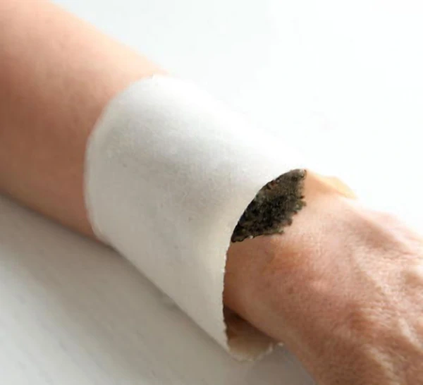 Cataplasma: come realizzare questo antico rimedio  e come usarlo nel modo corretto