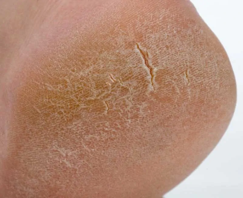 Talloni screpolati con ragadi