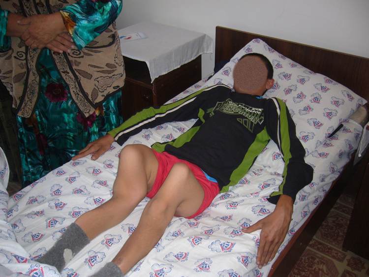 Bambino con arti deformati in Uzbekistan